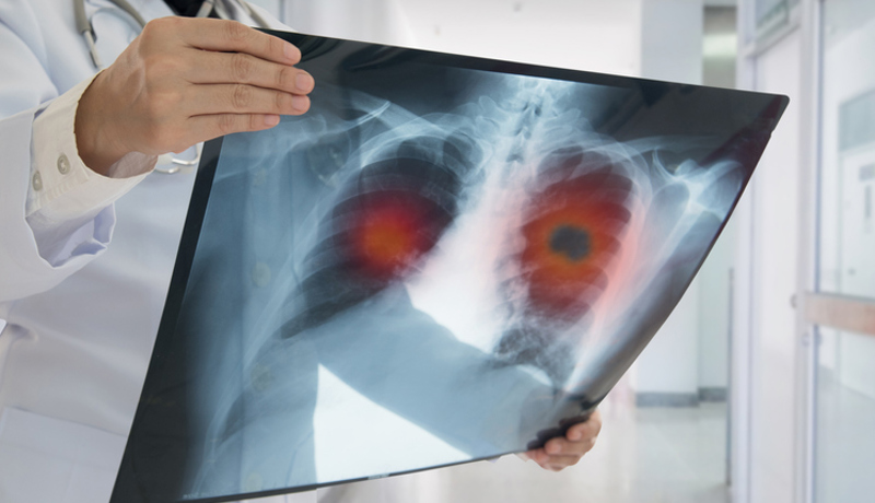 Röntgenbild Thorax Brustkorb Lunge Arzt Istock 920406350